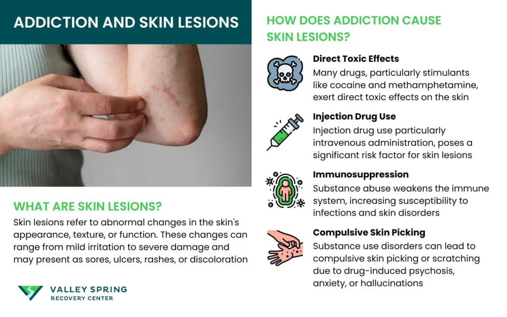 Addiction and Skin Lesions: A Comprehensive Study