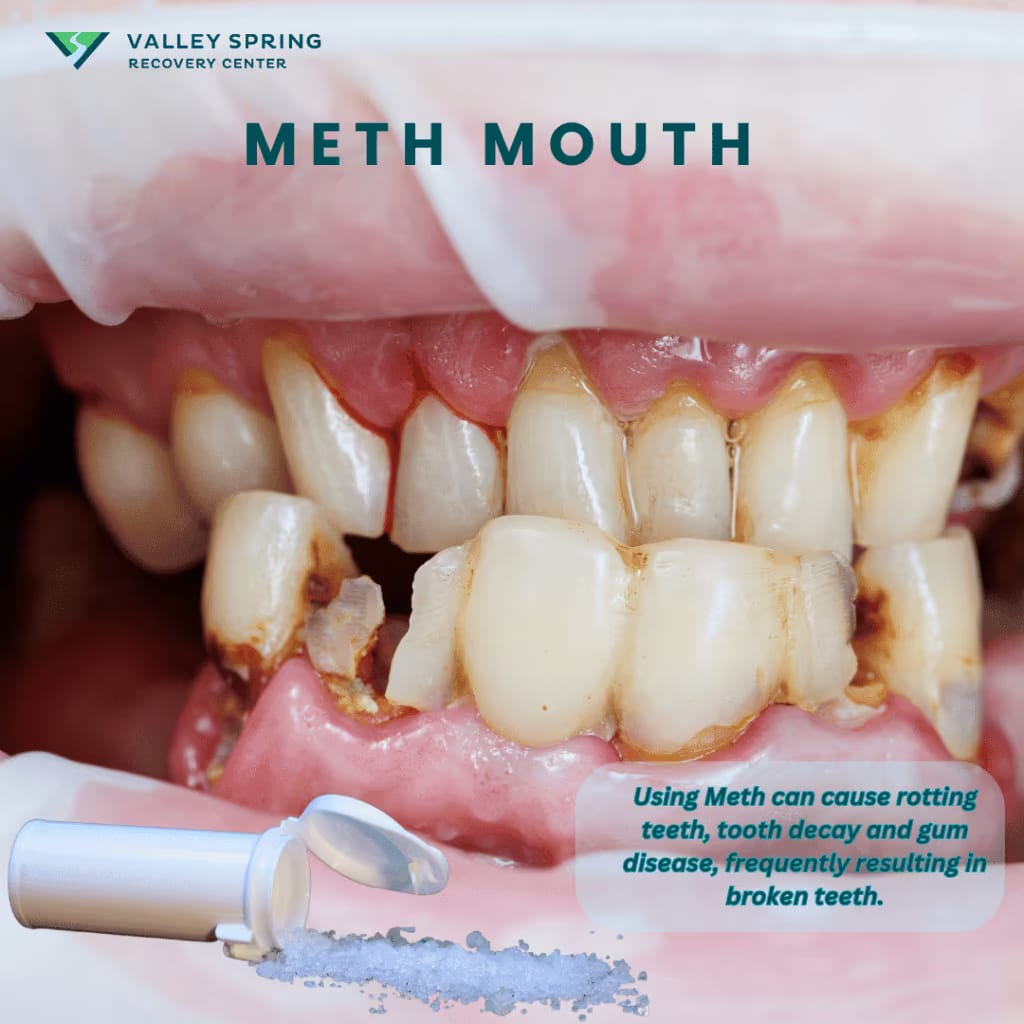 Meth Mouth, rotting teeth from abuse of methamphetamines
