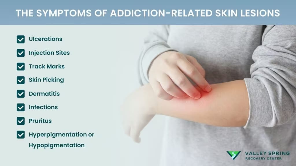 The Symptoms of Addiction-related Skin Lesions