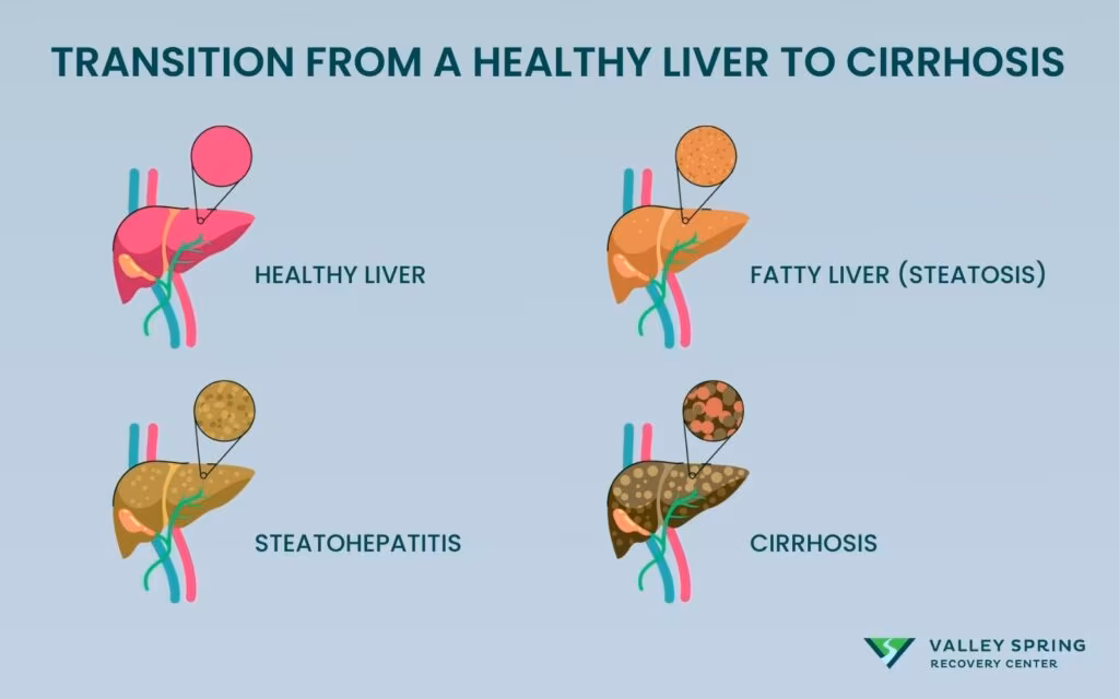 Alcohol and Liver Cirrhosis Alcohol and Liver Cirrhosis