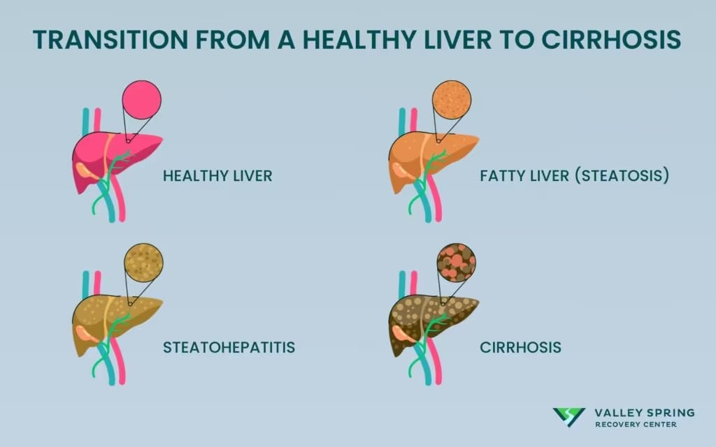 Alcohol and Liver Cirrhosis