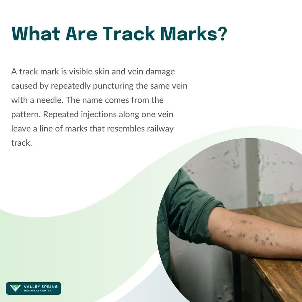 What are track marks — repeated needle injection marks along a vein on the forearm